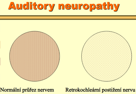 Auditory neuropathy průřez nervem